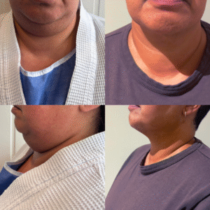 Fettsugning dubbelhaka